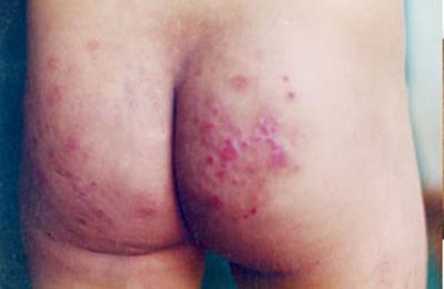 Eczema hậu môn: thời gian dài ẩm ướt ngứa quanh hậu môn