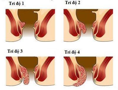 5 hình ảnh sa búi trĩ thường gặp nhất  Hồng Phúc