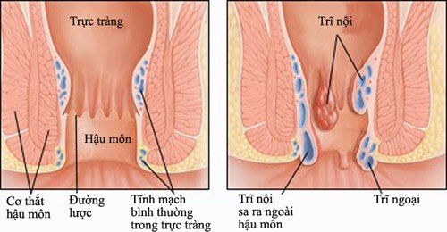 Bệnh trĩ và hiện tượng của nó
