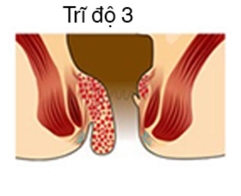 Bệnh trĩ cấp độ 3 gây ra những biến chứng gì?