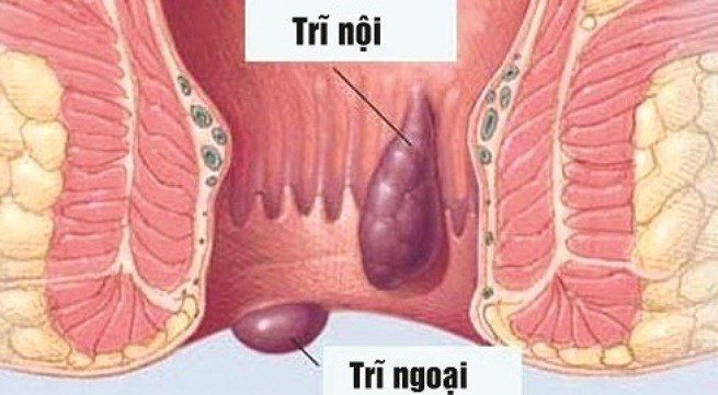 Cách phân biệt bệnh trĩ nội trĩ ngoại