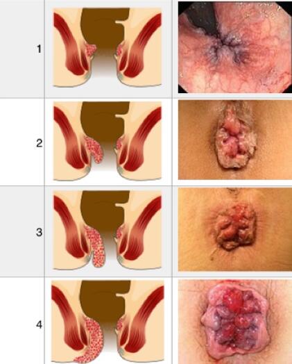 Các cấp độ bệnh trĩ – Thông tin không thể bỏ lỡ