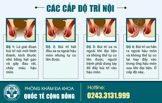 Sa Búi Trĩ Là Gì - Búi Trĩ Lòi Ra Ngoài Phải Làm Sao?
