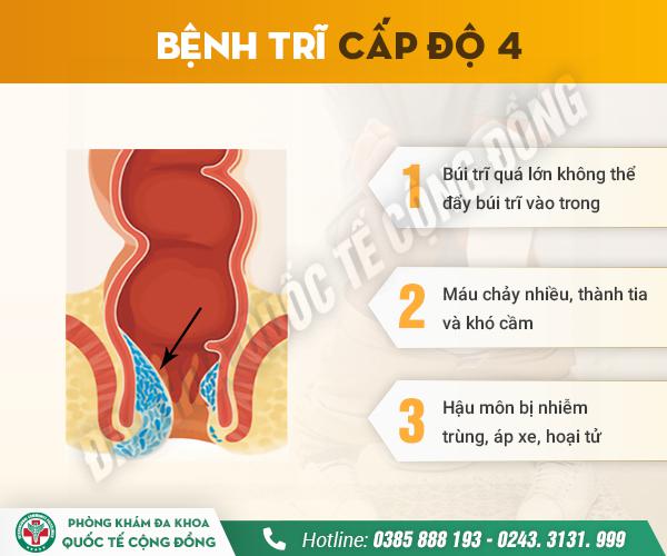 Cấp độ trĩ ngoại: Nhẹ thì khó chịu – Nặng thì đau đớn, biến chứng!