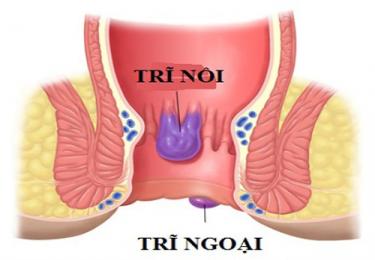 Những điều cần biết về bệnh trĩ ngoại độ 2