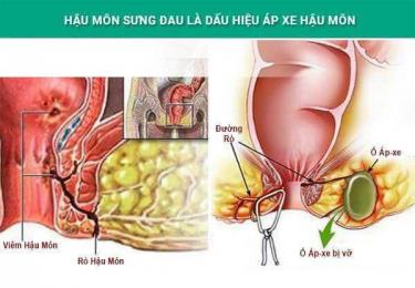Sưng đau hậu môn là bệnh gì?