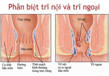 Phân biệt trĩ nội và trĩ ngoại