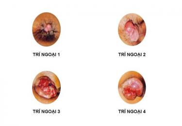 Các cấp độ của bệnh trĩ ngoại