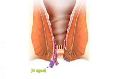 Chuyên gia chỉ ra dấu hiệu, triệu chứng trĩ ngoại dễ mắc phải
