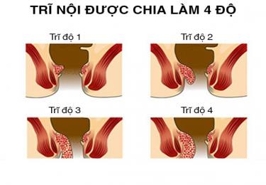 Đừng chủ quan với những biểu hiện của bệnh trĩ nội