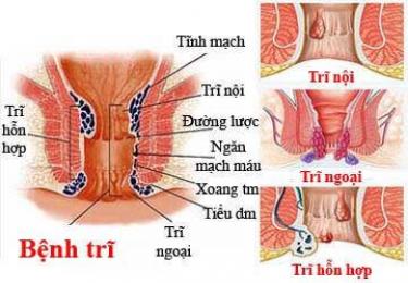 Cảnh báo biến chứng của búi trĩ bạn không nên bỏ qua