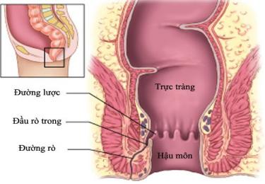 Nguyên nhân gây bệnh rò hậu môn bạn cần biết