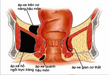 Tổng quát về bệnh lý nguy hiểm vùng hậu môn - apxe hậu môn