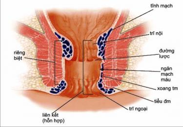Cách điều trị trĩ hỗn hợp nhanh chóng, hiệu quả