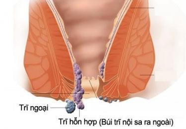 Bệnh trĩ hỗn hợp và những thông tin không thể bỏ qua