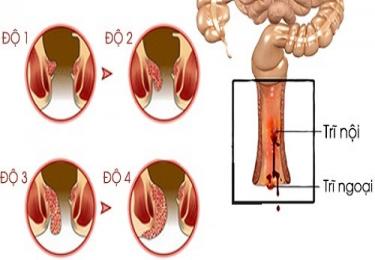 Những nguy hại khôn lường từ trĩ hỗn hợp