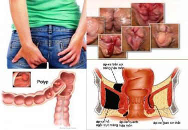Đau hậu môn - Dấu hiệu cảnh báo bệnh trĩ và các bệnh nguy hiểm