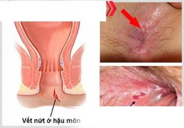Trị nứt kẽ hậu môn như thế nào hiệu quả, giảm nguy cơ tái phát?